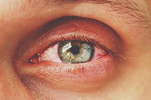 Κόκκινα Μάτια: Αιτίες και αντιμετώπιση